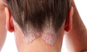 Khám và tư vấn sức khỏe miễn phí cho bệnh nhân vẩy nến