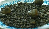 Cụ bà có 806 viên sỏi trong túi mật