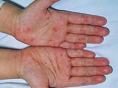 Đề phòng bệnh chân tay miệng biến chứng Đề phòng bệnh chân tay miệng biến chứng