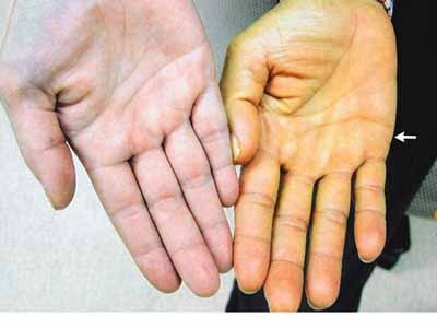 Thay đổi bất thường trên da, coi chừng bệnh nguy hiểm Thay đổi bất thường trên da, coi chừng bệnh nguy hiểm