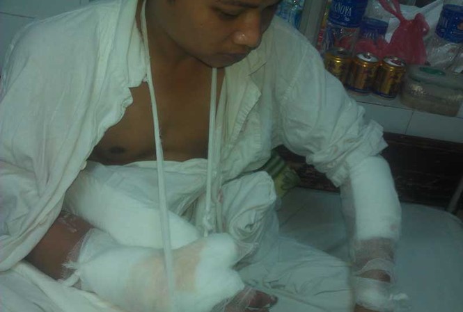 Bị chém lìa tay vì 'dám cưa gái làng' Bị chém lìa tay vì 'dám cưa gái làng'