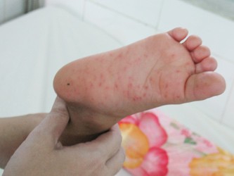 Bệnh nhi thứ hai tử vong có thể do bệnh tay chân miệng Bệnh nhi thứ hai tử vong có thể do bệnh tay chân miệng