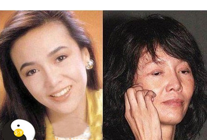 Hàng trăm ngàn người bị hủy hoại gương mặt vì… làm đẹp Một cô gái trở thành bà già sau ca giải phẫu thẩm mỹ