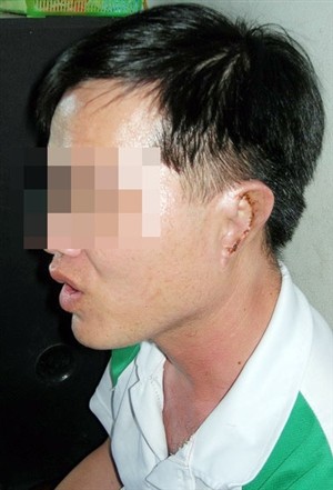Phó Bí thư bị người tình xẻo tai làm đơn bãi nại Phó Bí thư bị người tình xẻo tai làm đơn bãi nại