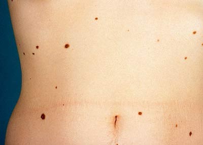 Nốt ruồi, khi nào là ung thư? Nốt ruồi, khi nào là ung thư?