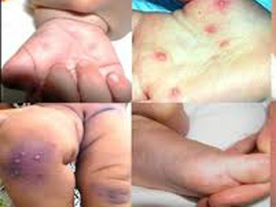 Người lớn đầu tiên ở Quảng Trị mắc bệnh tay chân miệng Người lớn đầu tiên ở Quảng Trị mắc bệnh tay chân miệng