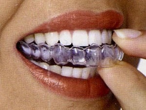 Lắp bộ răng mới nhờ máy in xương công nghệ 3D Lắp bộ răng mới nhờ máy in xương công nghệ 3D