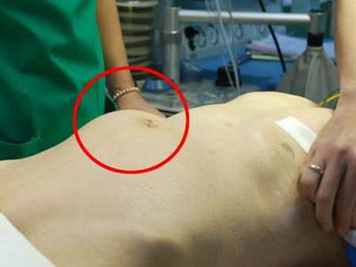 Cách mới trị phình động mạch bụng Cách mới trị phình động mạch bụng