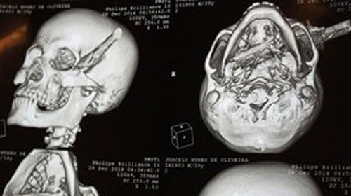 Sống sót dù bị dao đâm vào sâu vào đầu Vị trí con dao xuyên qua đầu của Juacelo Nunes de Oliveira. Ảnh: 9news.com.au