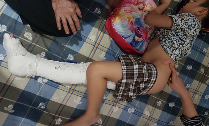 Học sinh gãy chân ở trường: Phụ huynh 'tố', trường nói 'vô can' Xương đùi phải của Kiên bị gãy, phải bó bột.