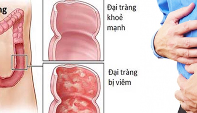 “Khổ” như bị viêm đại tràng mạn tính Viêm đại tràng có thể làm cản trở khả năng hấp thu chất dinh dưỡng và calo của cơ thể