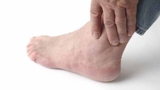 Những thực phẩm người bệnh gout tuyệt đối không nên ăn Những thực phẩm người bệnh gout tuyệt đối không ăn