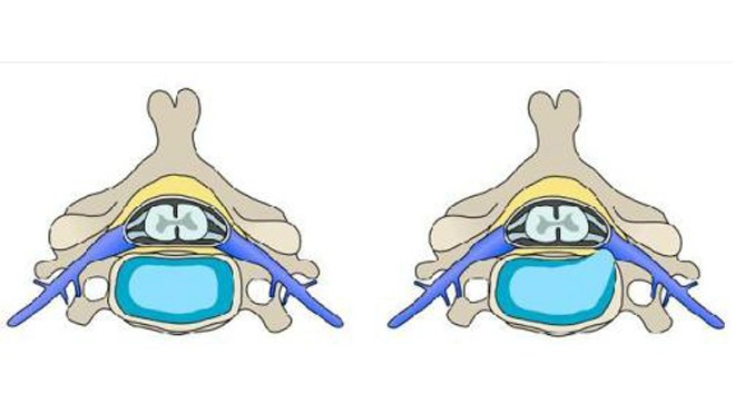 Dấu hiệu thoát vị đĩa đệm cột sống cổ Ảnh bên phải cho thấy nhân nhầy thoát ra tạo thành khối thoát vị chèn ép vào rễ thần kinh gây ra bệnh.