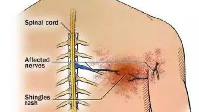 Dễ biến chứng lâu dài nếu điều trị giời leo không đúng cách Zona có thể gây biến chứng nghiêm trọng là đau dây thần kinh.