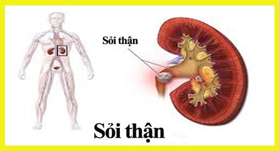 Sỏi thận: Căn bệnh nguy hiểm không chừa một ai Sỏi thận: Căn bệnh nguy hiểm không chừa một ai
