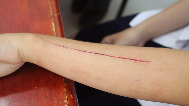 Sự thật nữ sinh lớp 10 bị bạn dùng lưỡi lam rạch tay tại lớp học Vết thương của Q khiến nhiều phụ huynh hoang mang, lo lắng.