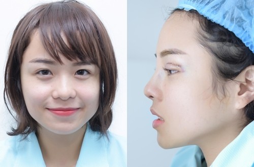 Thái Trinh sửa mũi, cắt mí mắt để tự tin hơn Thái Trinh trước và sau phẫu thuật thẩm mỹ (phải).