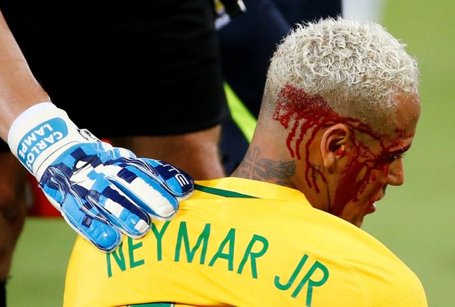 Neymar rách mí mắt, bị treo giò ở trận gặp Venezuela Neymar bị rách mí mắt ở trận đấu với Bolivia.