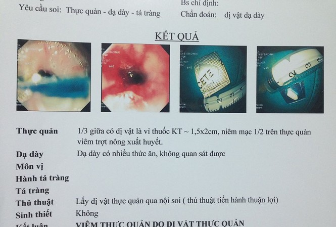 Quên động tác này khi uống thuốc, nam thanh niên nhập viện cấp cứu Hình ảnh viên thuốc còn nguyên vỏ bọc trong thực quản bệnh nhân