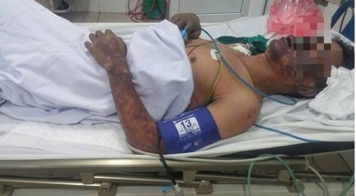 Người đàn ông bị ban hoại tử toàn thân vì ăn tiết canh “lợn cắp nách” Bệnh nhân bị ban hoại tử chủ yếu ở mặt và các chi