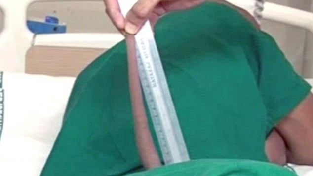 'Cậu bé thần khỉ' được cắt đuôi dài 18cm vì không ngồi được Chiếc đuôi dài tới 18 cm của thiếu niên ở Ấn Độ.