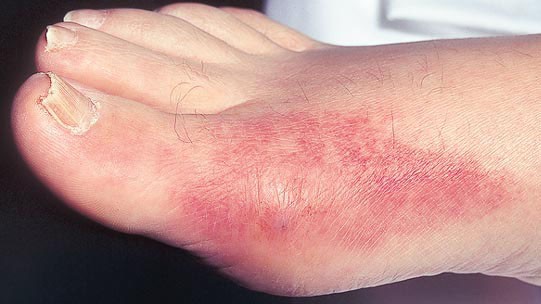 Gút và bệnh giả gút – Phân biệt như thế nào? Cơn gút cấp thường khởi phát ở khớp ngón chân cái.