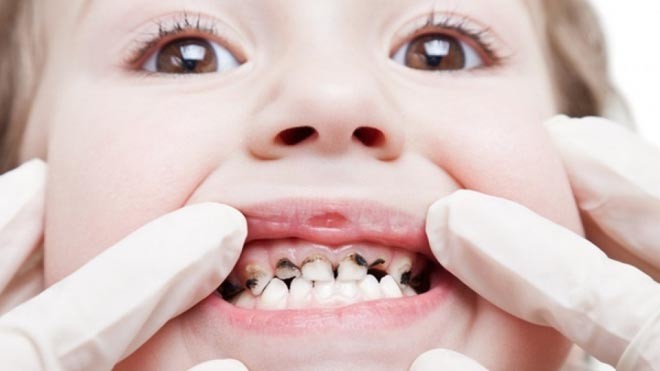 Dịch chiết sáp ong - Bước đột phá mới từ thiên nhiên giúp lợi chắc, răng bền Sâu răng là một trong những nguyên nhân gây mất răng sớm