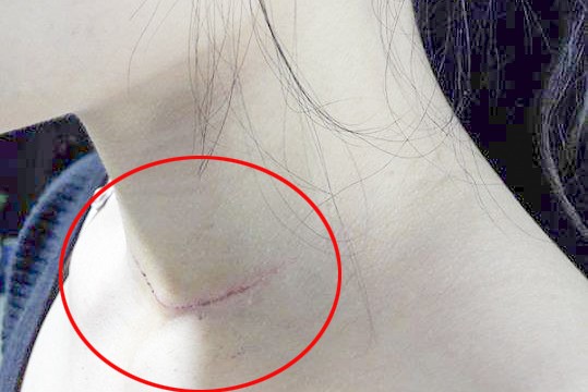 Cô gái trẻ bị chém vào cổ ngay trước cửa nhà Vết thương trên cổ nạn nhân. Ảnh: CTV.