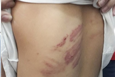 Bắt tạm giam ông bố đánh dã man con gái học lớp 4 Nhiều vết thương trên người bé gái.