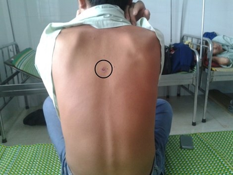 Trưởng công an xã bị tố bắn, đánh dân nhập viện Vết thương trên lưng Nhân được cho là bị đạn cao su bắn trúng