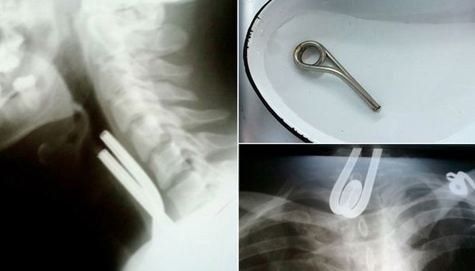 Suýt chết vì nuốt nhầm chốt sắt Ảnh chụp X-quang bệnh nhân khó thở vì chốt sắt nằm chắn trong cổ họng.