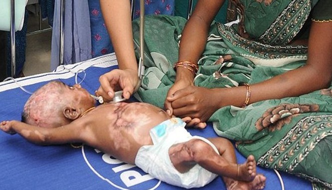 Bí ẩn gia đình có 2 bé trai tự bốc cháy Cậu bé Rahul nhập viện hồi tháng 8-2013. Ảnh: Daily Mail.