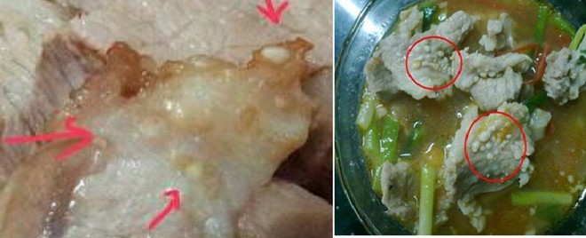 Động kinh, mù mắt vì sán gạo heo làm tổ trên da - ảnh 1