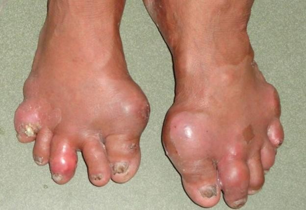 Chữa bệnh gout bằng bài thuốc bí truyền - ảnh 1