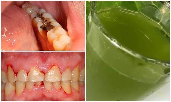 Trị sâu răng đơn giản với bài thuốc từ lá bàng - ảnh 7