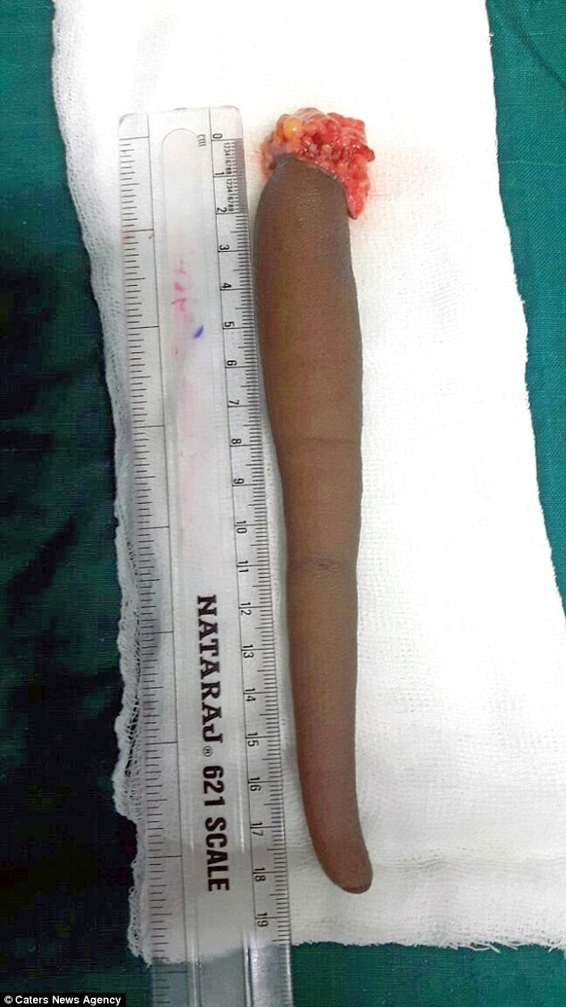 'Cậu bé thần khỉ' được cắt đuôi dài 18cm vì không ngồi được - ảnh 3