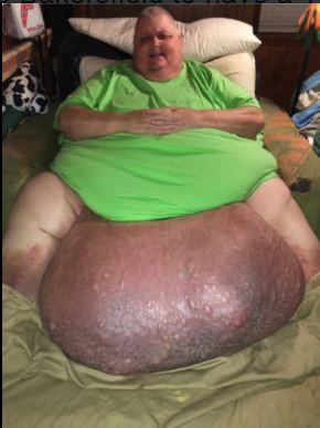Tưởng béo bụng hóa ra khối u nặng 60kg - ảnh 2