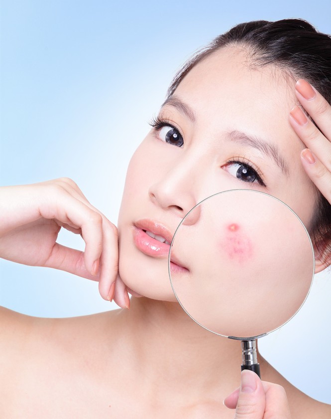 Bí quyết loại bỏ mụn trứng cá bọc - ảnh 1