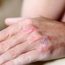 Giảm triệu chứng của bệnh vẩy nến - ảnh 1