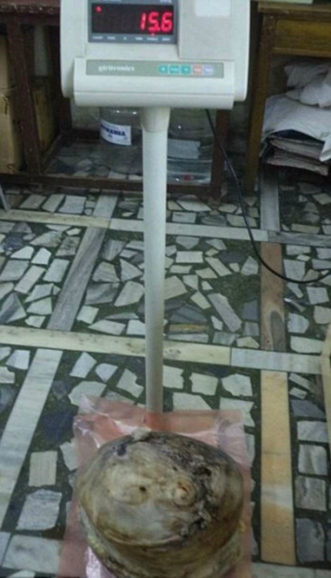 Khối u xơ tử cung có thể nặng tới hơn 15kg - ảnh 1