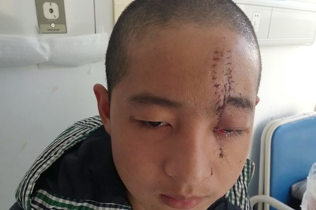 Sống sót thần kỳ dù bị lưỡi cưa găm vào đầu - ảnh 2