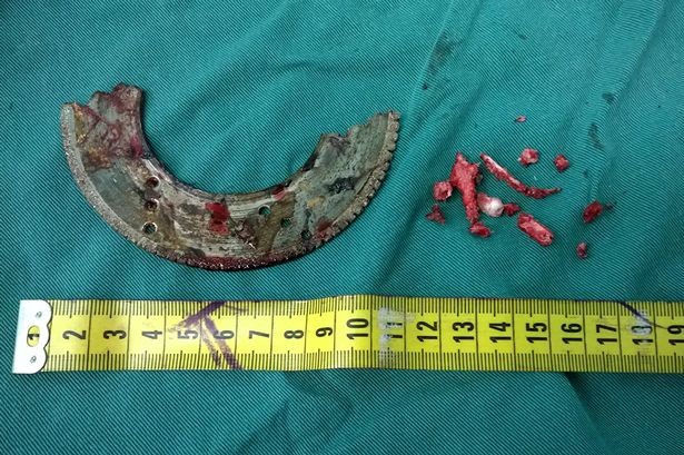 Sống sót thần kỳ dù bị lưỡi cưa găm vào đầu - ảnh 3
