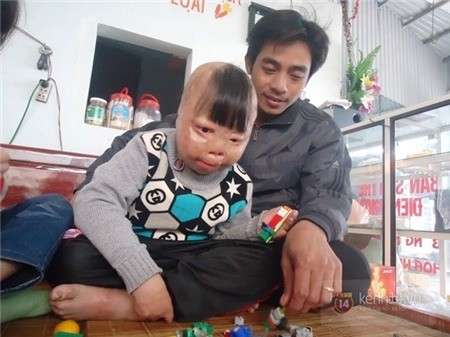 Hành trình 4 năm sống sót của cậu bé bị cha ruột đổ xăng đốt - ảnh 5