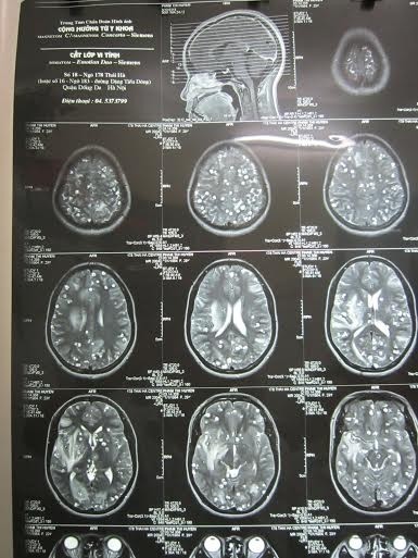 Kinh hoàng giun, sán ăn lục phủ ngũ tạng người - ảnh 2