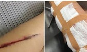 Công an làm việc với người tung tin thiếu nữ bị cướp rạch tay giữa phố