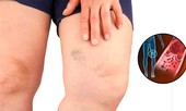 7 triệu chứng tiềm ẩn của chứng huyết khối tĩnh mạch cần đề phòng