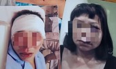 Khởi tố người chồng đánh vợ biến dạng mặt vì ghen