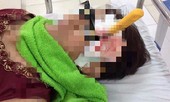 Té ngã khi cạo vôi tường, người phụ nữ bị dao đâm xuyên não