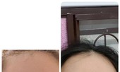 Thẩm mỹ ở cơ sở 'dỏm', đau đớn vì mắt không thể nhắm kín