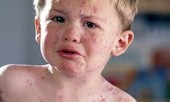 Trẻ bị thủy đậu phải kiêng nước, kiêng gió?